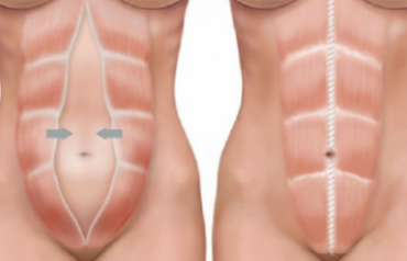 diastasis abdominal